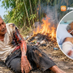 Kurang Hati-Hati Saat Bakar Sampah, Lansia di Magetan Alami Luka Bakar 68 Persen